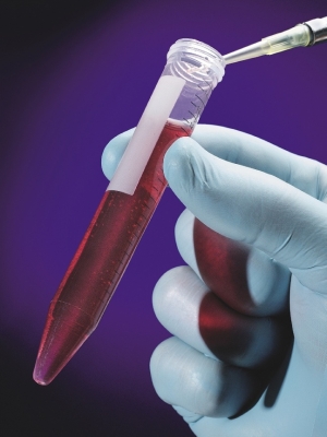 Анализы крови для диагностики рака простаты
