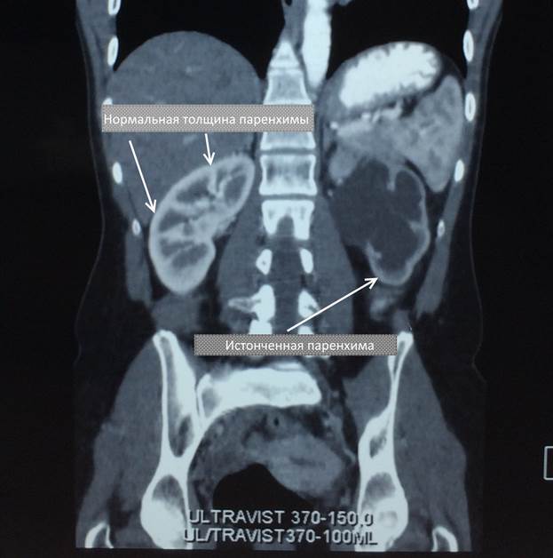 Мультиспиральная компьютерная томография, левая почка расширена, паренхима истончена