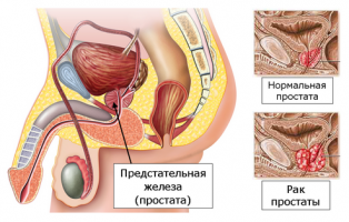adenoma prostata psa elevato)