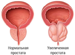 Острая задержка мочи: Причины, симптомы и лечение | sauna-chelyabinsk.ru
