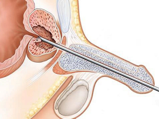 ТУР (трансуретральная резекция) гиперплазии простаты происходит через уретру - без разрезов